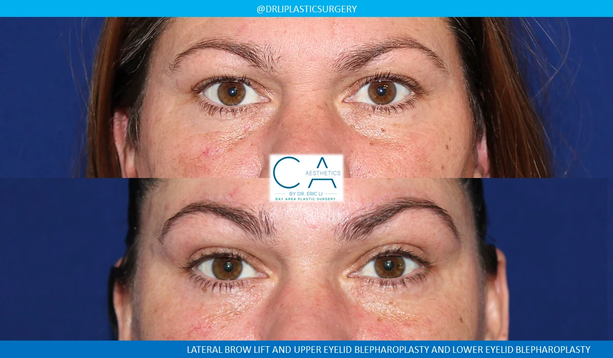 2 – Lateral Brow Lift and Upper and Lower Eyelid Blepharoplasty AP