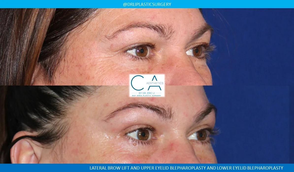 2 – Lateral Brow Lift and Upper and Lower Eyelid Blepharoplasty Oblique