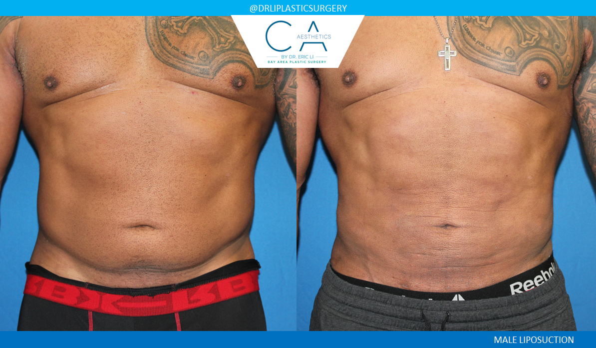 2 – Male Liposuction AP