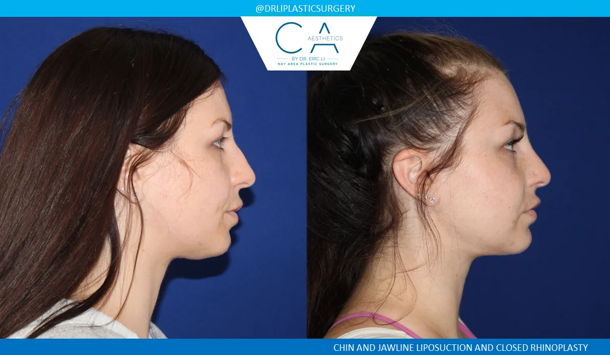 2 – Rhinoplasty and Chin Liposuction Lateral