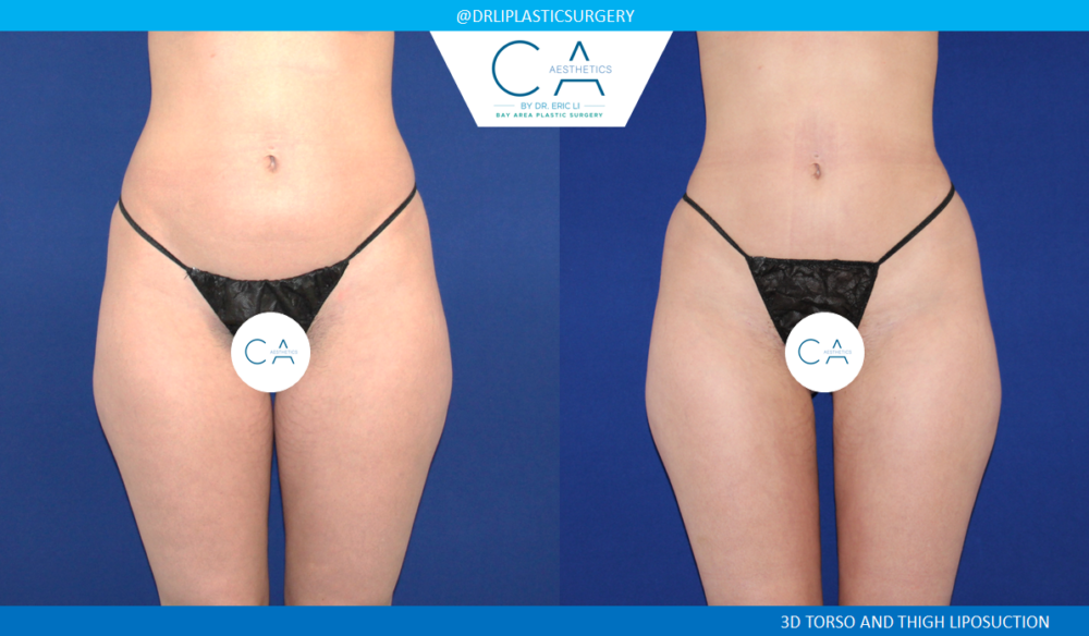 Leg Liposuction case #4976