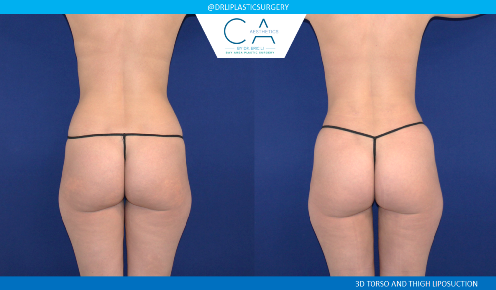 Leg Liposuction case #4976