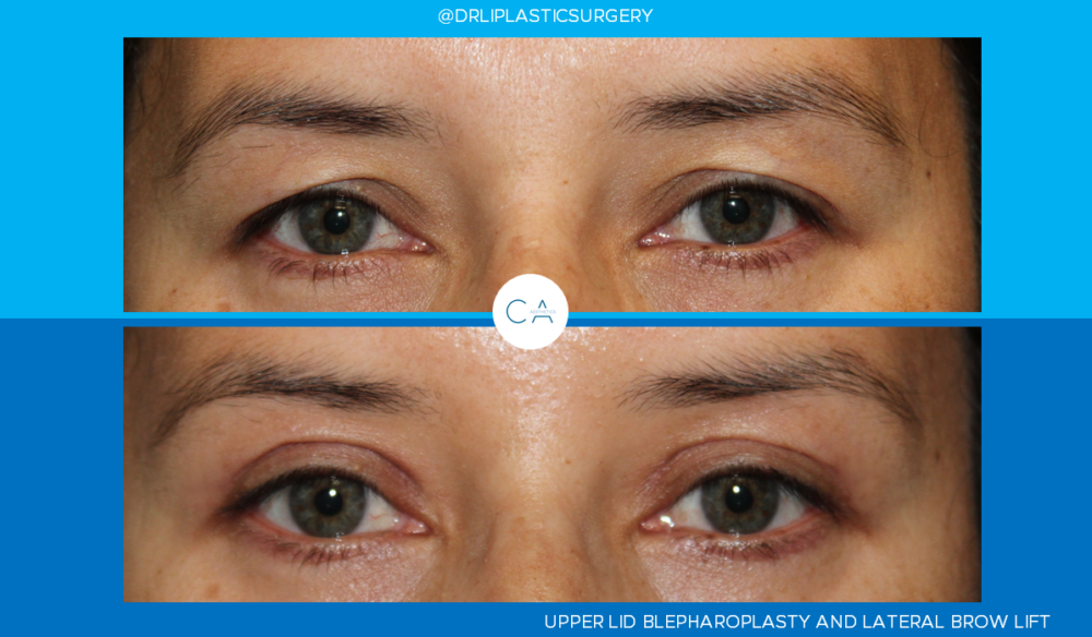 Upper Blepharoplasty case #4641