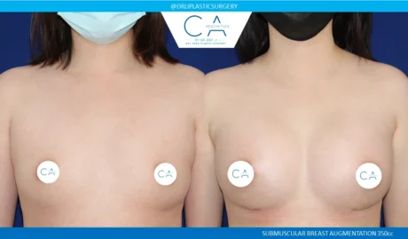 Breast Augmentation case #5214