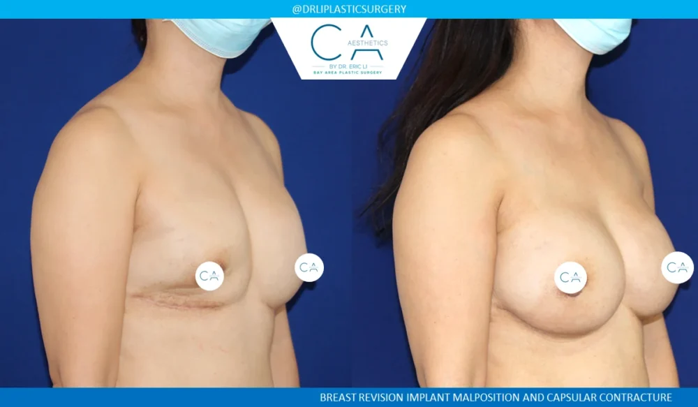 Breast Reconstruction case #5300