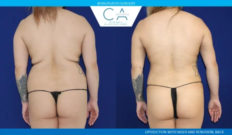 360 Liposuction (Torso) case #5509