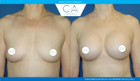 Breast Augmentation case #5213