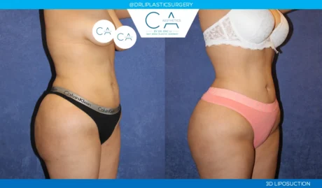 360 Liposuction (Torso) case #5508