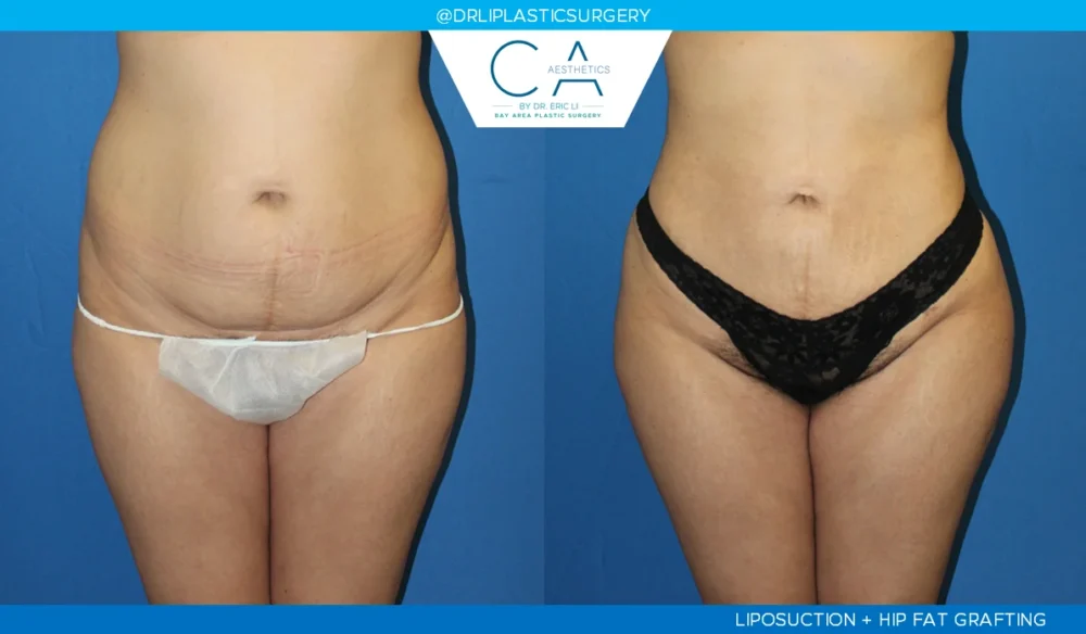 360 Liposuction (Torso) case #5507