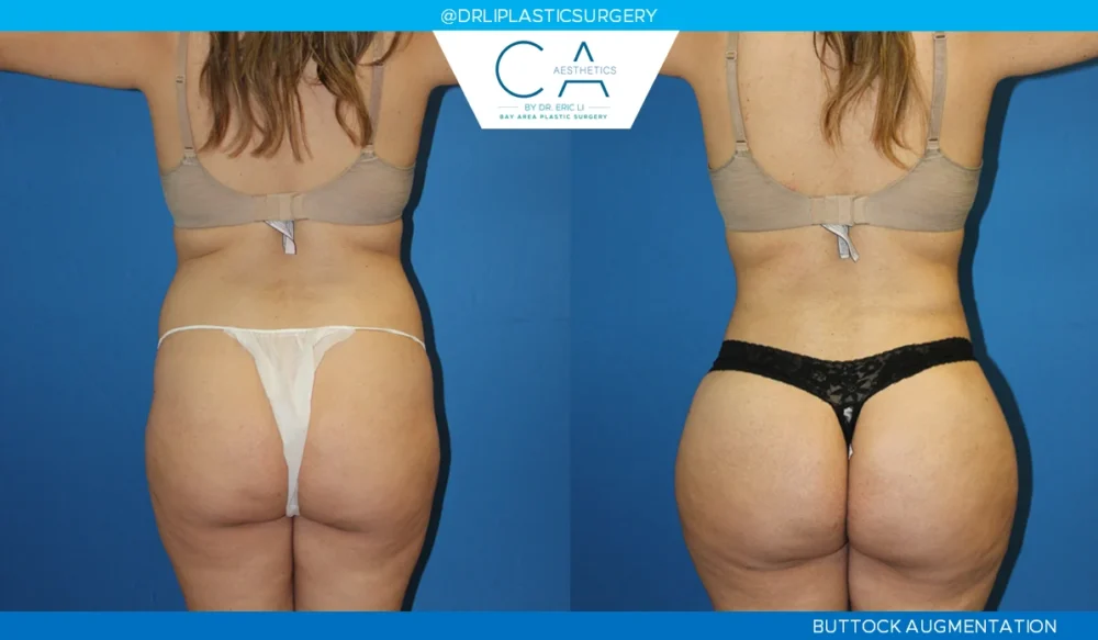 360 Liposuction (Torso) case #5507