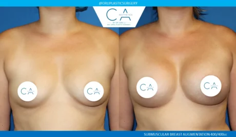 Breast Augmentation case #5211