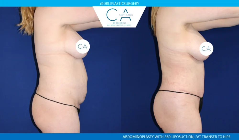 360 Liposuction (Torso) case #5505