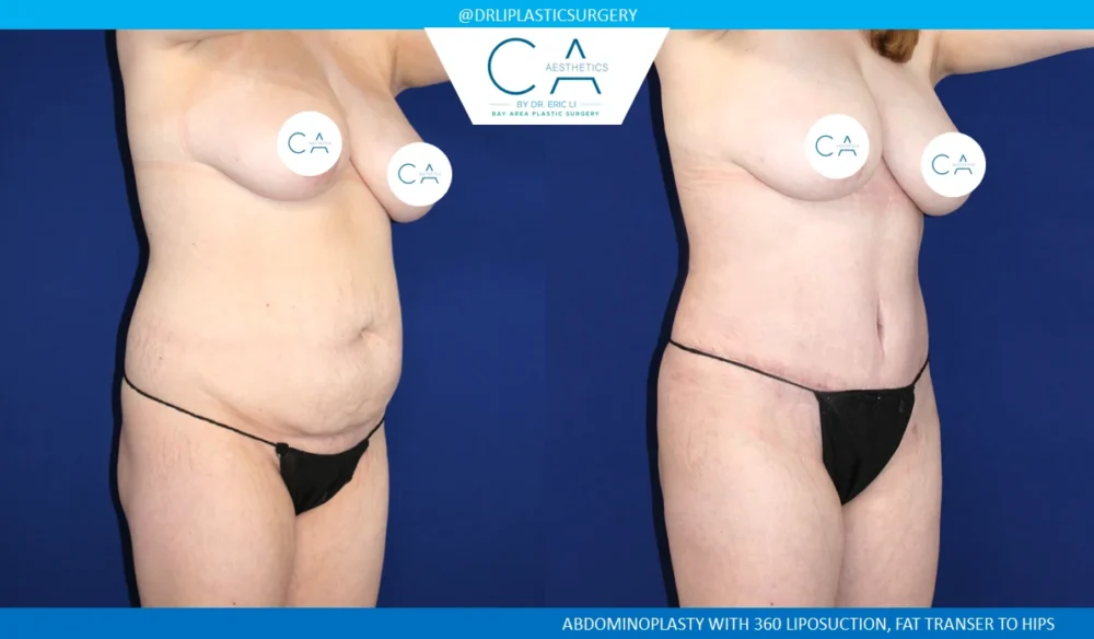 360 Liposuction (Torso) case #5505