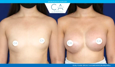 Breast Augmentation case #5209