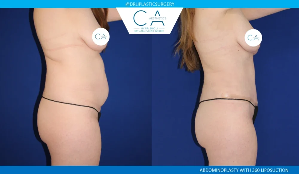 360 Liposuction (Torso) case #5501