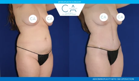 360 Liposuction (Torso) case #5501