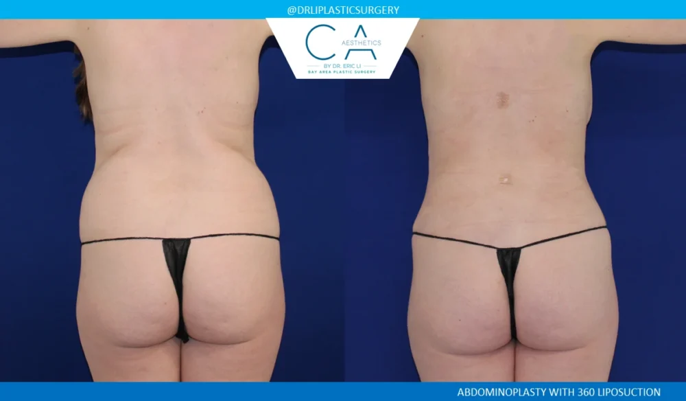 360 Liposuction (Torso) case #5501