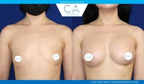 Breast Augmentation case #5208