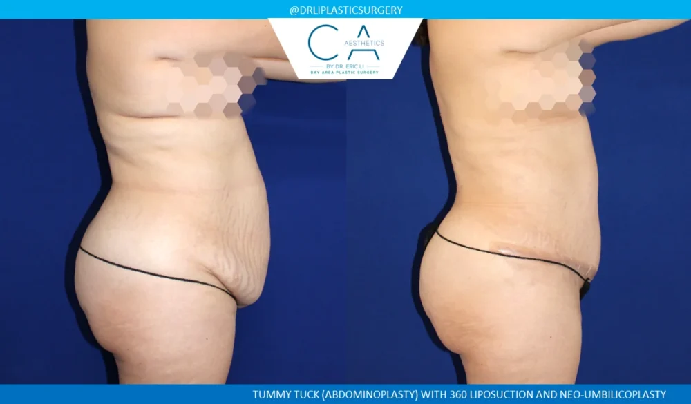 360 Liposuction (Torso) case #5500