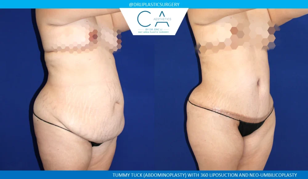 360 Liposuction (Torso) case #5500