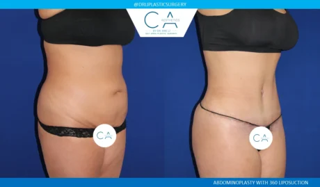 360 Liposuction (Torso) case #5499