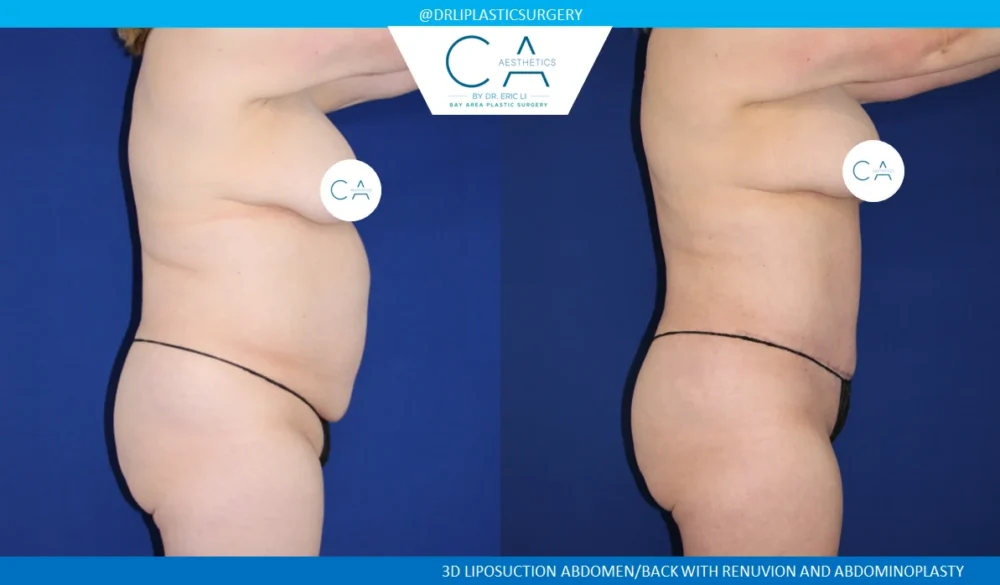 360 Liposuction (Torso) case #5495