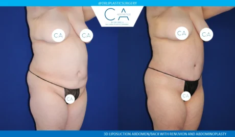 360 Liposuction (Torso) case #5495