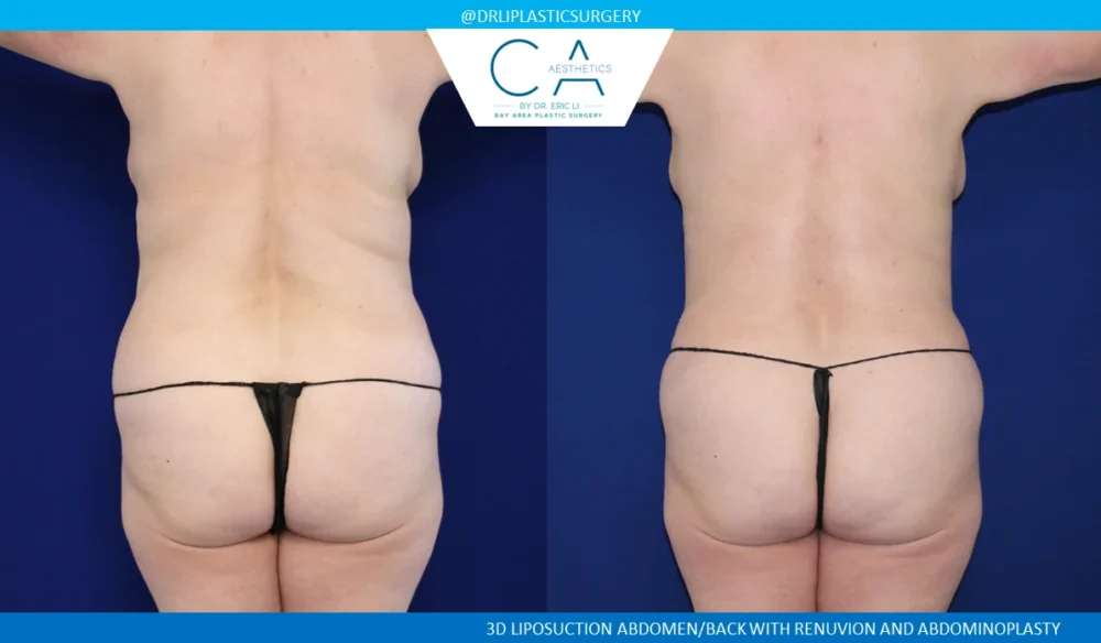 360 Liposuction (Torso) case #5495