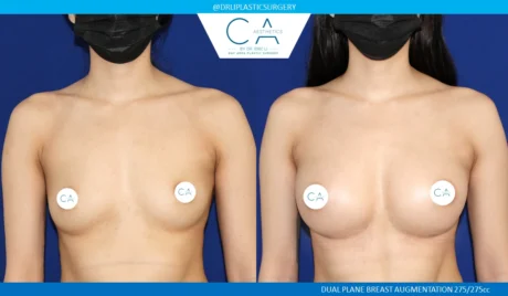 Breast Augmentation case #5205