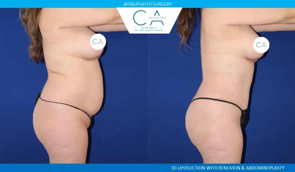 360 Liposuction (Torso) case #5494