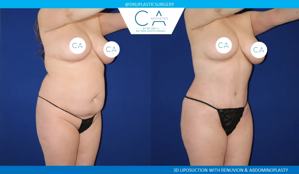 360 Liposuction (Torso) case #5494