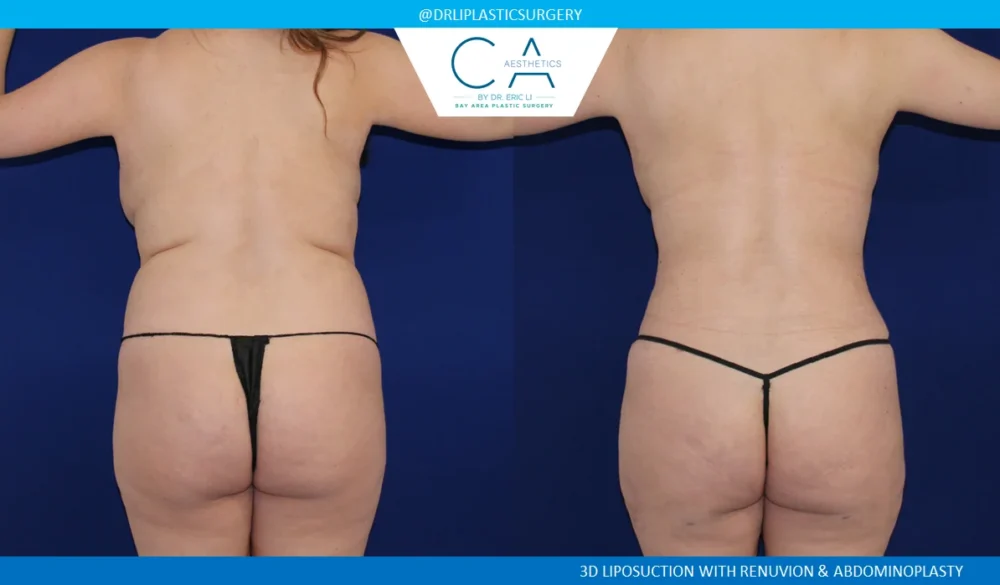 360 Liposuction (Torso) case #5494