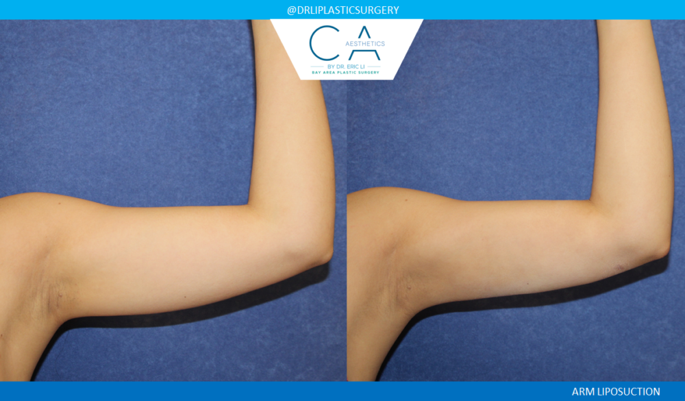 Arm Liposuction case #4568