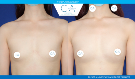 Fat Transfer Breast Augmentation case #4847