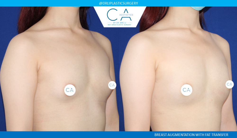 Fat Transfer Breast Augmentation case #4847