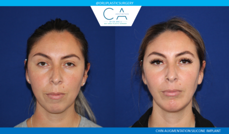 Facial Implants and Fat Transfer case #4757