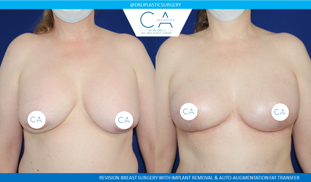 Breast Implant Removal case #4934