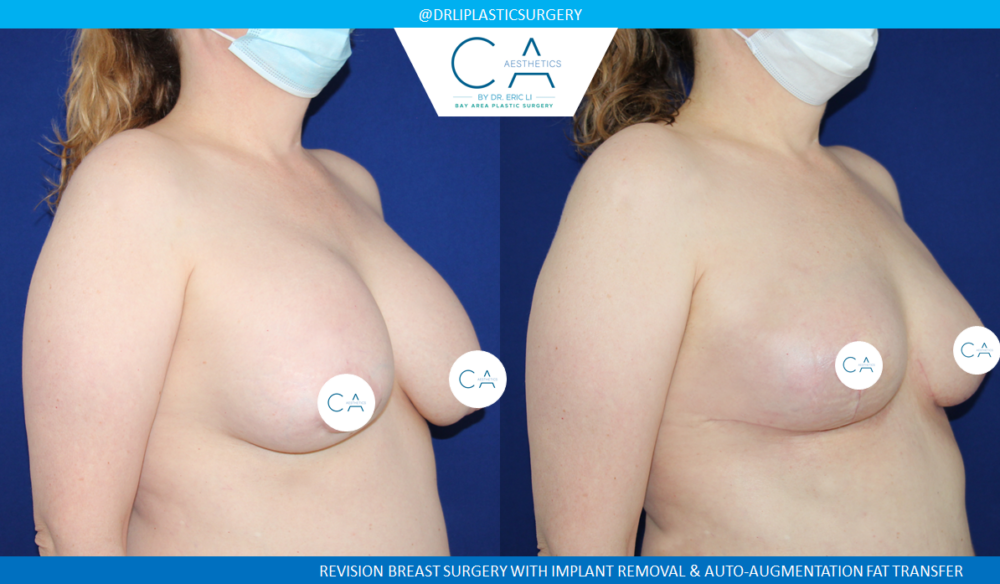 Breast Implant Removal case #4934