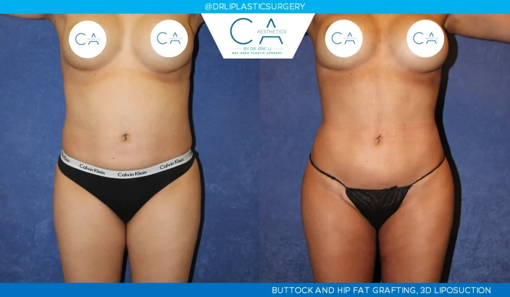 360 Liposuction (Torso) case #5528