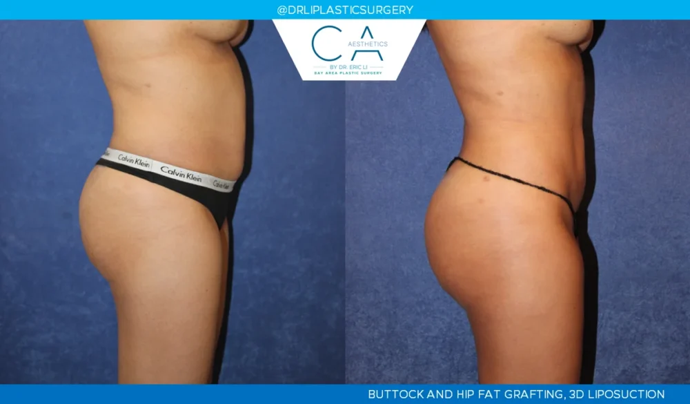 360 Liposuction (Torso) case #5528