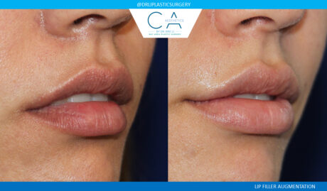 Fillers case #5068