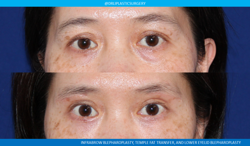 Lower Blepharoplasty (Eyelid Surgery) case #4731