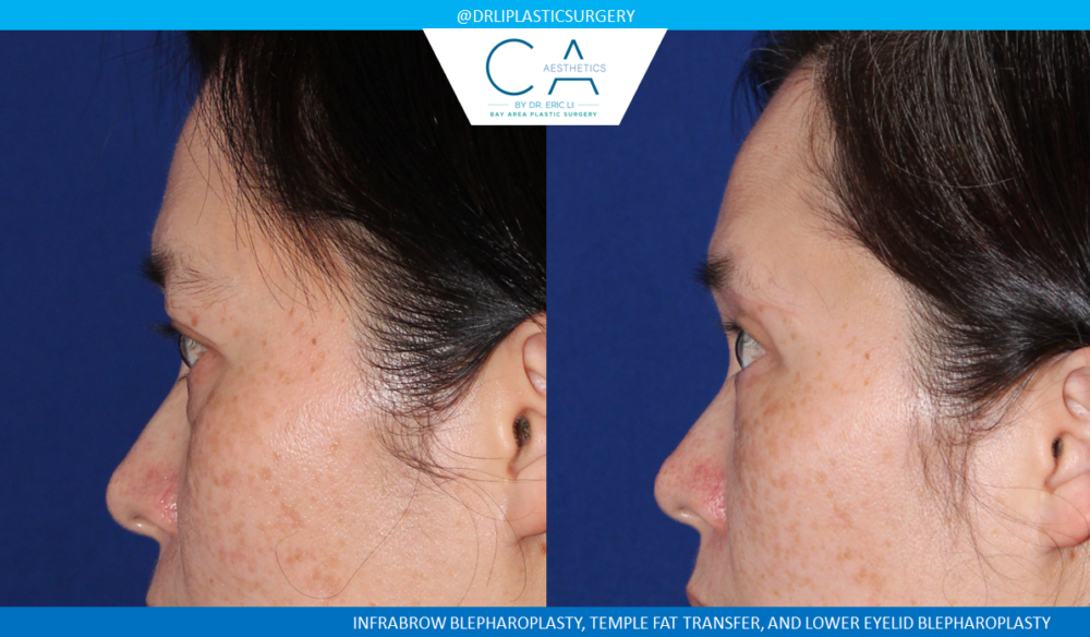 Lower Blepharoplasty (Eyelid Surgery) case #4731