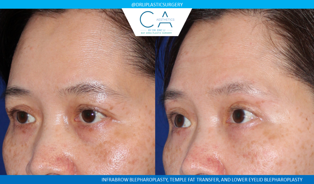 Lower Blepharoplasty (Eyelid Surgery) case #4731