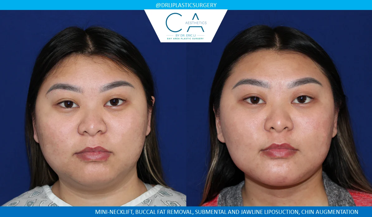 3 – Mini-Necklift, Chin Augmentation, Buccal Fat Removal, Submental Jawline Liposuction AP