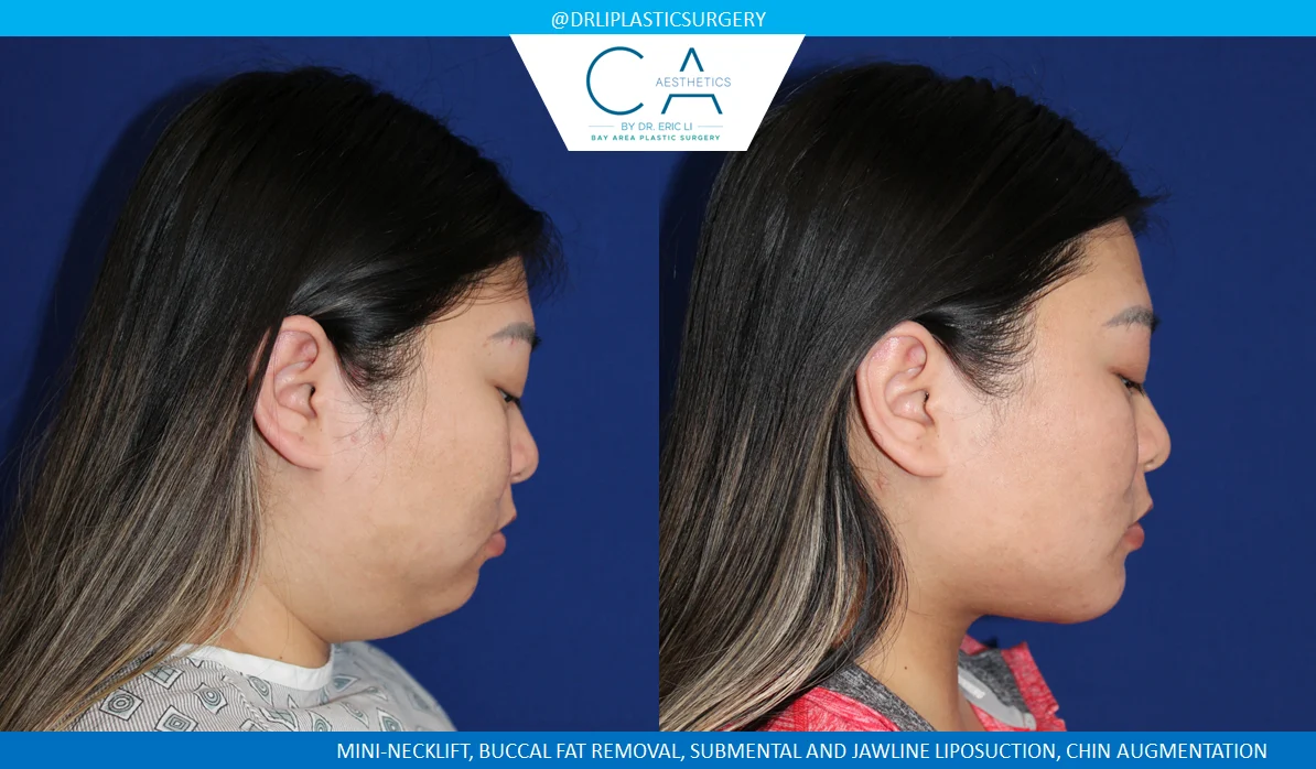 3 – Mini-Necklift, Chin Augmentation, Buccal Fat Removal, Submental Jawline Liposuction Lateral 2