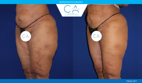 Thigh Lift case #4914