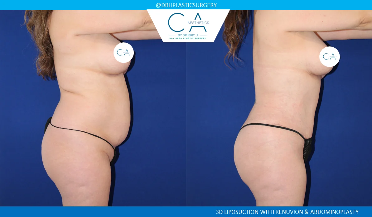 3 – Tummy Tuck Lateral