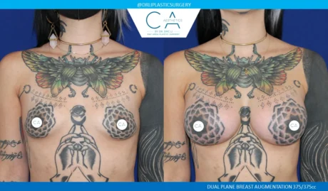 Breast Augmentation case #5204