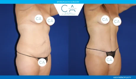 360 Liposuction (Torso) case #5493